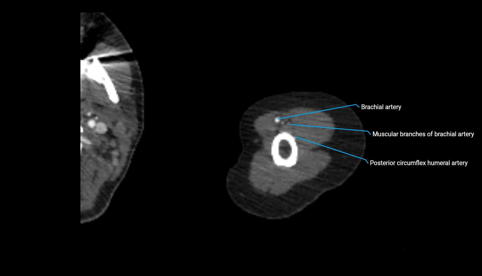 CTA upper limb axial cross sectional anatomy labelled image 284 (2).webp